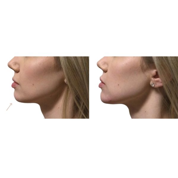 Facial Balancing with Fillers Before and After 2