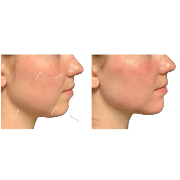 Facial Balancing with Fillers Before and After 4