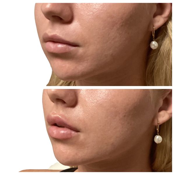 Lip Filler Before and After 9