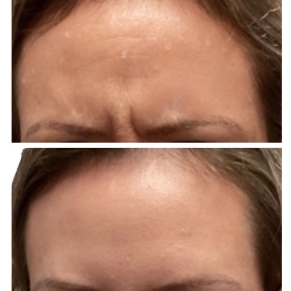 Wrinkle Relaxers Before and After 1