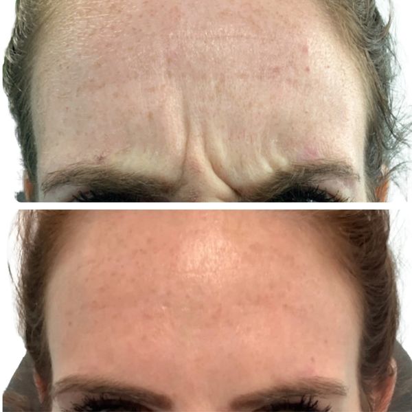 Wrinkle Relaxers Before and After 3
