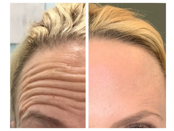 Wrinkle Relaxers Before and After 5