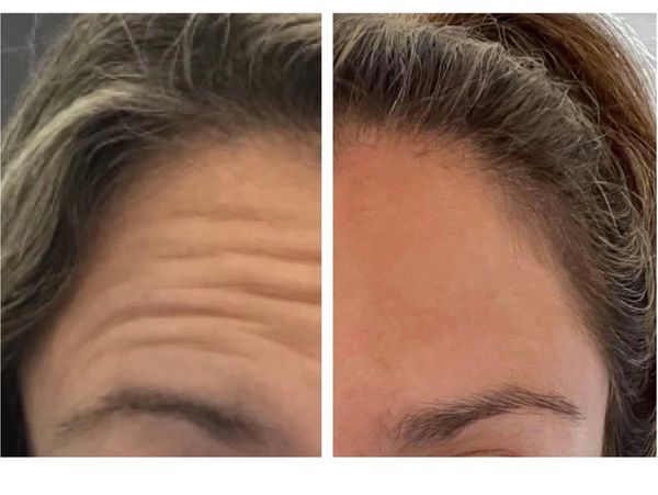 Wrinkle Relaxers Before and After 6